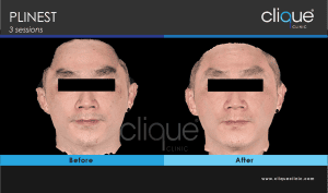 PLINEST for men - clique clinic
