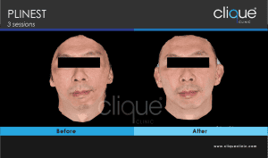 Read more about the article PLINEST before and after – Year 2024
