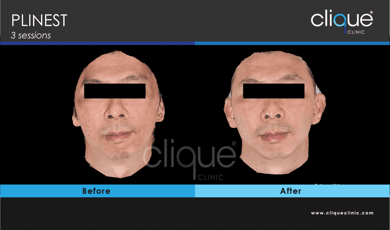 You are currently viewing PLINEST before and after – Year 2024