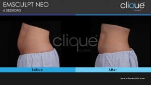 Read more about the article EMSculpt Neo Mommy Makeover 