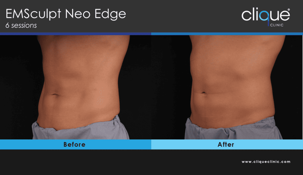 EMSculpt Neo Edge - what body problems can it fix? OR How EMSculpt NE0 & EDGE provides the most benefits - EMSculpt Neo Edge before and after 1 1 3