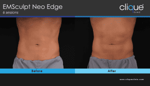 EMSculpt Neo Edge before and after