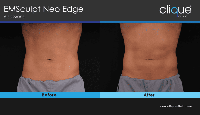 Read more about the article EMSculpt Neo Edge – what body problems can it fix? OR How EMSculpt NE0 & EDGE provides the most benefits