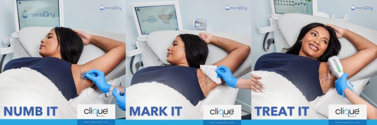 Read more about the article Hyperhidrosis Treatment in Malaysia: Top Options for Excessive Sweating