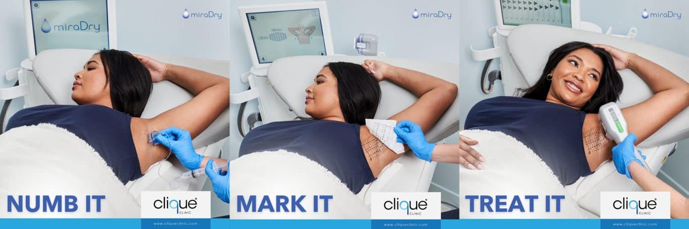 You are currently viewing Hyperhidrosis Treatment in Malaysia: Top Options for Excessive Sweating