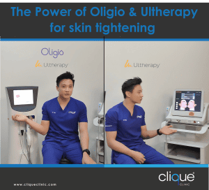 The Power of Oligio vs Ultherapy for skin tightening