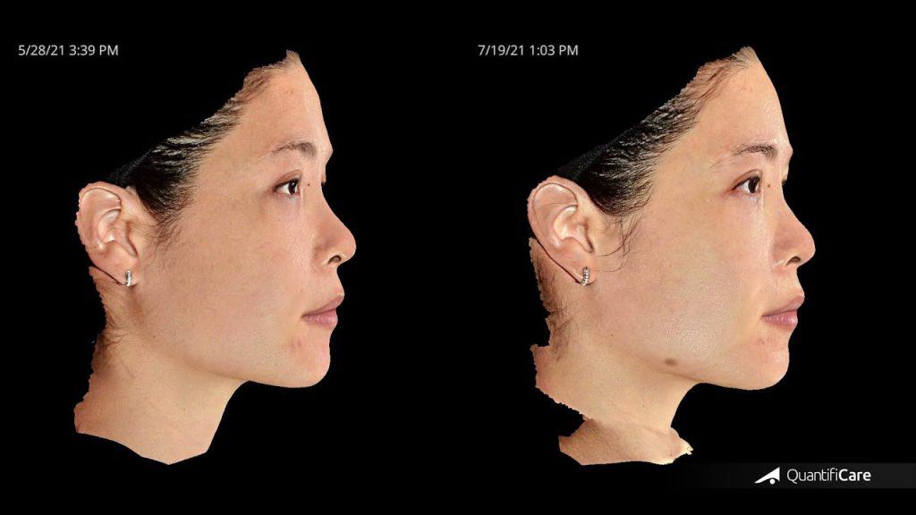 Everything You Need to Know About Ultherapy - ultherapy malaysia e69cace5 1