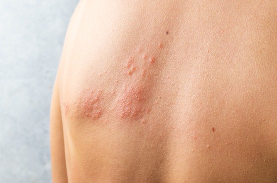 Kayap: Penyebab, Gejala, dan Pengubatan Penyakit Kulit dan Saraf yang Disebabkan oleh Virus Varicella-Zoster - kayap 3 1