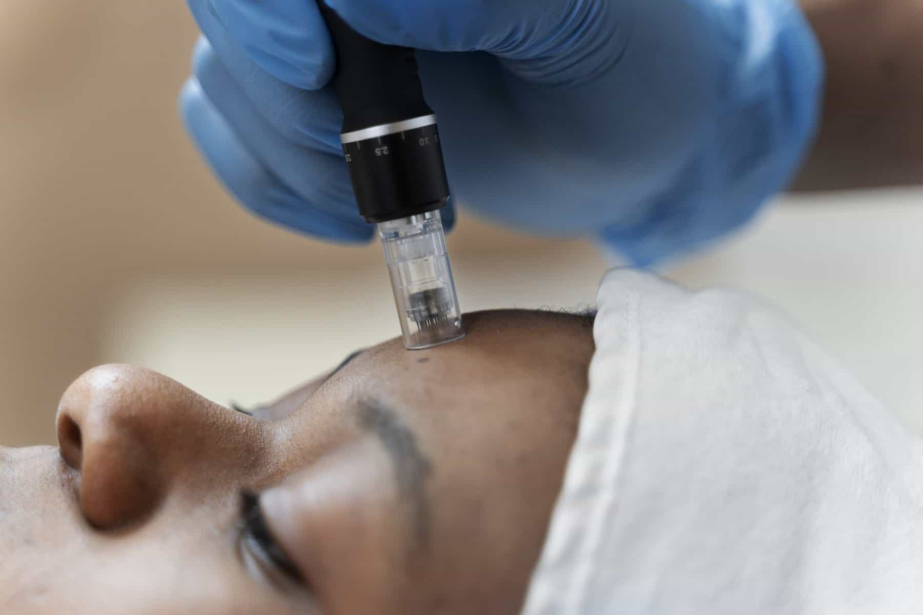 You are currently viewing Is Microneedling Beneficial For Acne Scars?