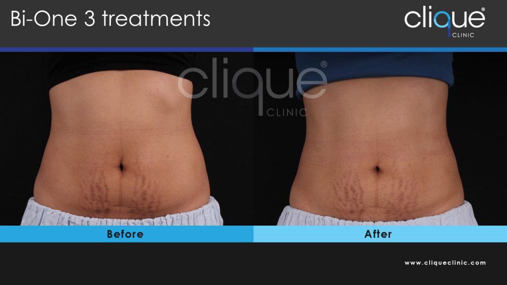 Stretch Marks Reduction