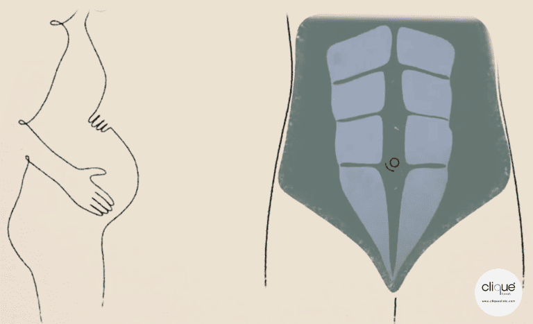 Read more about the article Rediscovering Self-Love in the Postpartum Recovery from Diastasis Recti and Stretch Marks