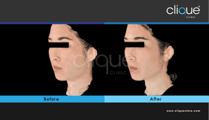 Skin tightening treatment #1