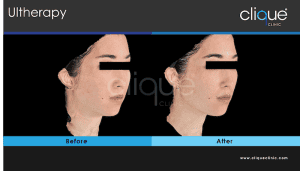 Skin tightening treatment #2