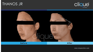 Acne - Acne 6