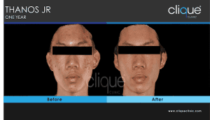 Acne treatment