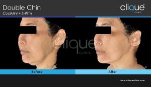 Skin tightening treatment #3