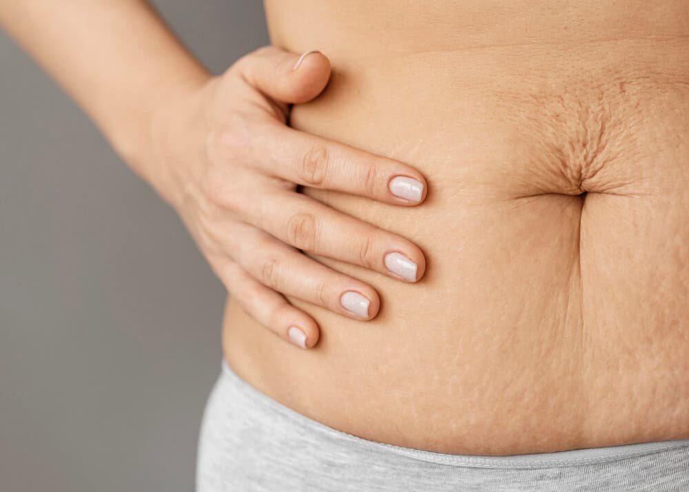 You are currently viewing Does Microneedling Help Reduce Stretch Marks?