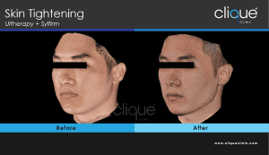 Skin tightening treatment #4
