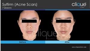 Acne - Sylfirm Acne TL 7