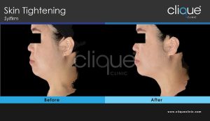 Skin tightening treatment Jawline