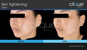 Skin tightening treatment Jawline