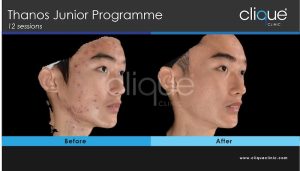 Acne treatment before and after #2