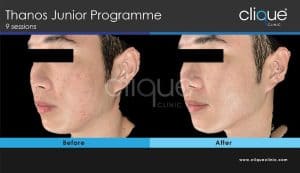 Acne treatment before and after #3