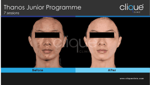Acne treatment before and after #5