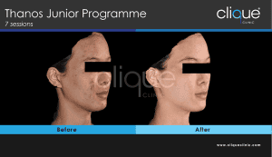 Acne treatment before and after #4