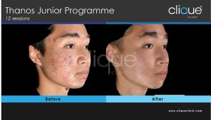 Acne treatment before and after #6