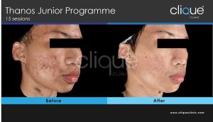 Acne treatment before and after #7