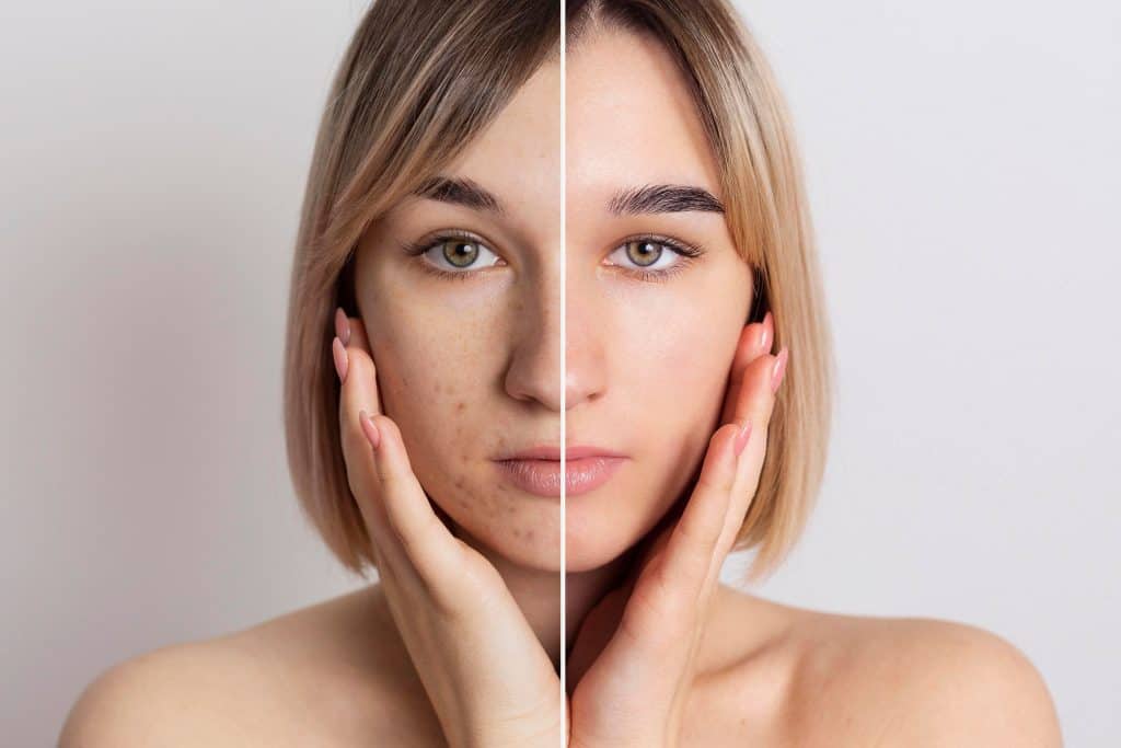 Pico Laser Treatment: Before & After - Pico Laser Before After Traetment 3 Face of a woman showing before and after Pico Laser Treatment