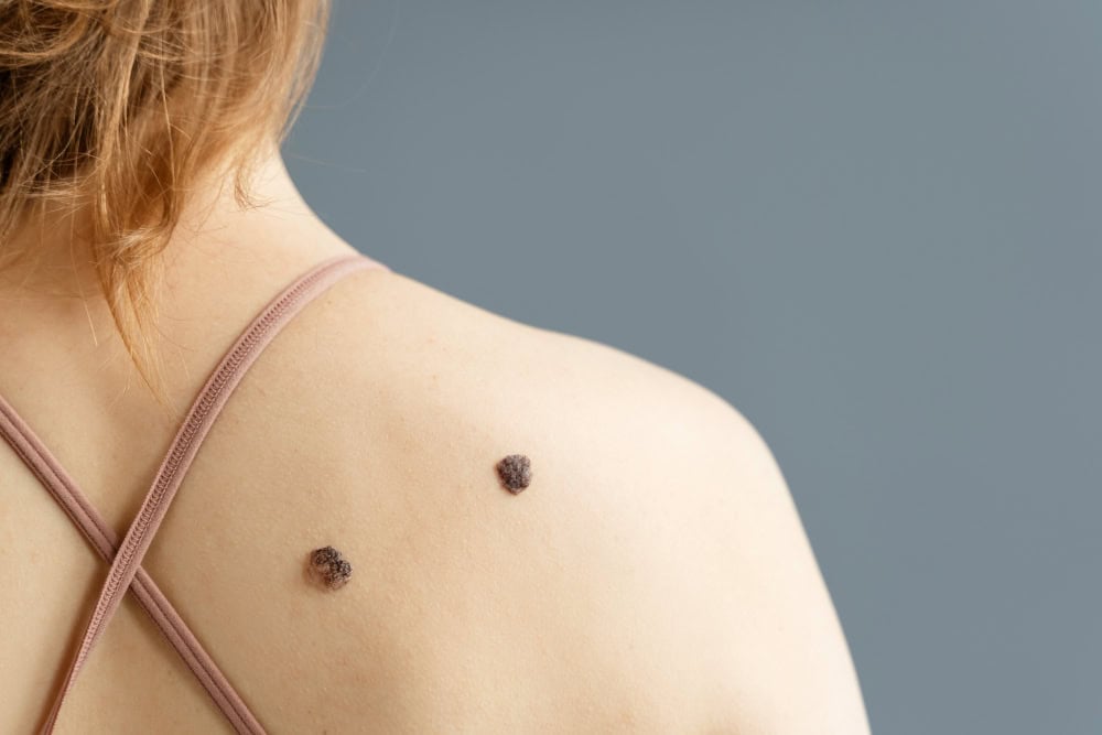 You are currently viewing Skin Tags: What Are They, Why They Develop & Removal Methods