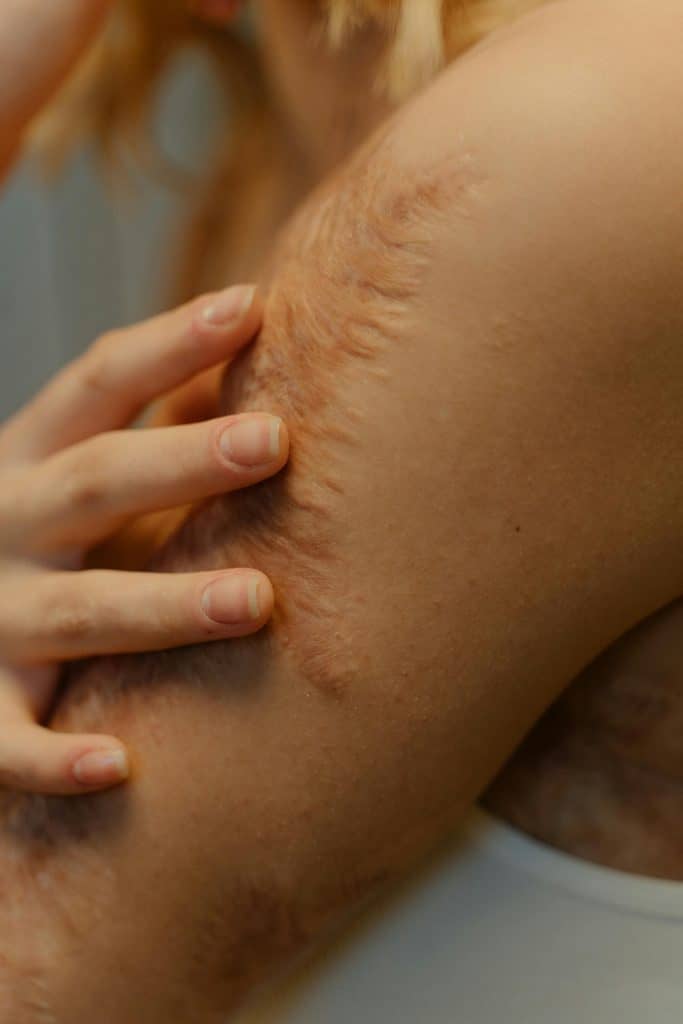 Pico Laser Treatment: Before & After - Surgical Scars 2 A woman's upper arm having surgical scar