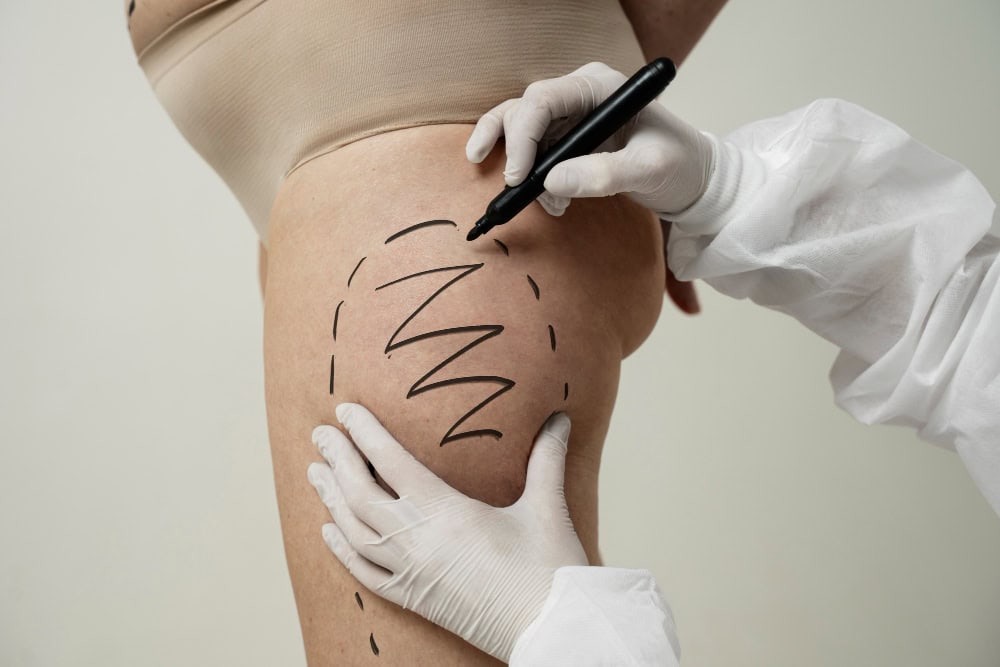 A person's thigh sagging being analysed by marking on the thighs, by a professional