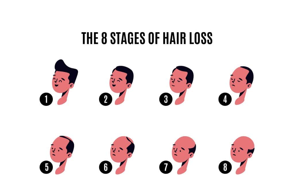 Hair Loss stages