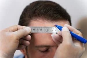 Read more about the article Receding Hairline in Men: Causes and Treatment Options