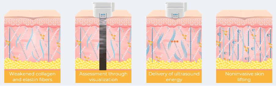 Ultherapy Prime (Trusted Face Lifting Solution) - How Ultherapy Prime works 2