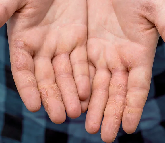 Dyshidrotic Eczema: Symptoms, Causes, Treatment