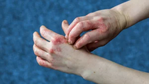 Read more about the article Dyshidrotic Eczema: Symptoms, Causes, Treatment