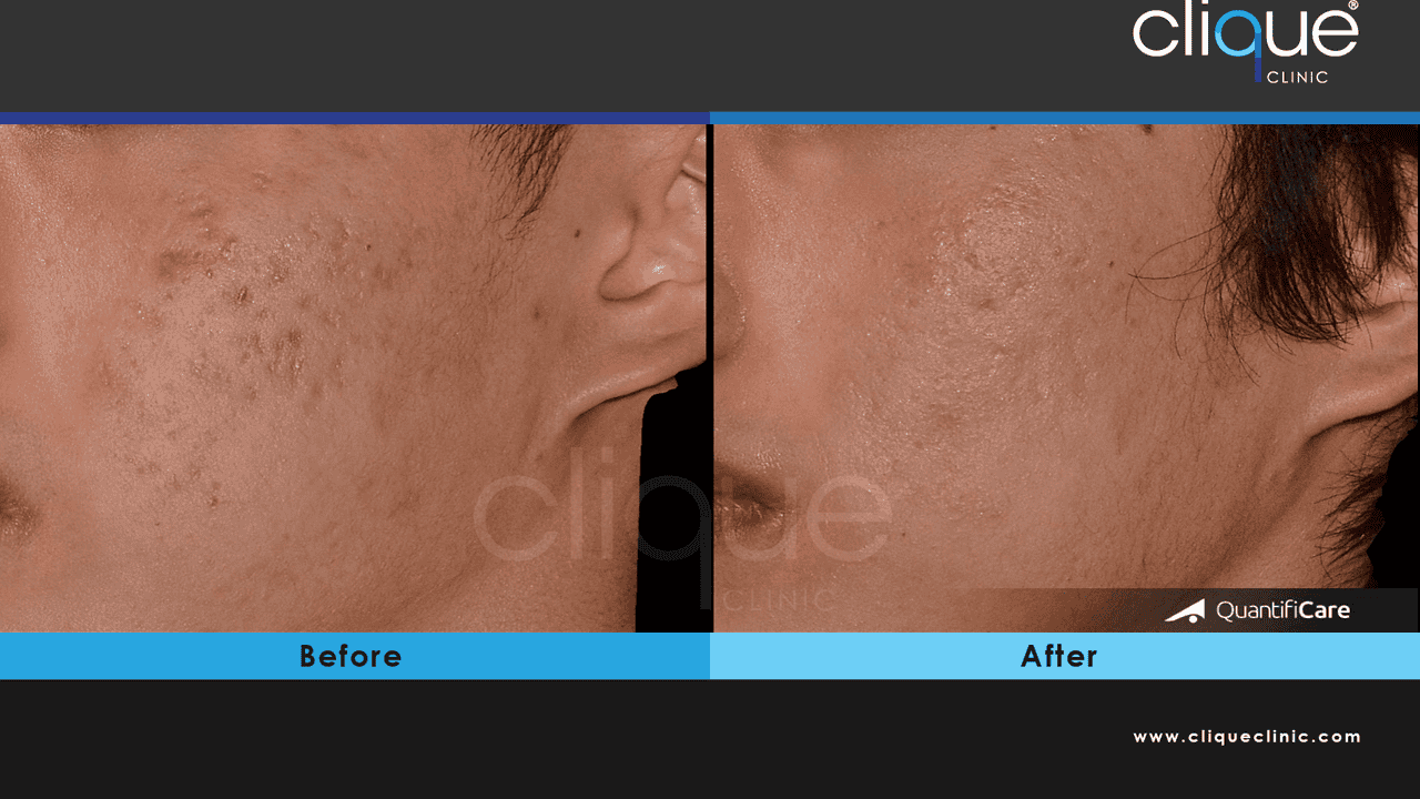 瘢痕・ケロイドはここまで治せる Less―Scar Wound Healing… 瘢痕・ケロイドはここまで治せる: Less-Scar Wound Healingの