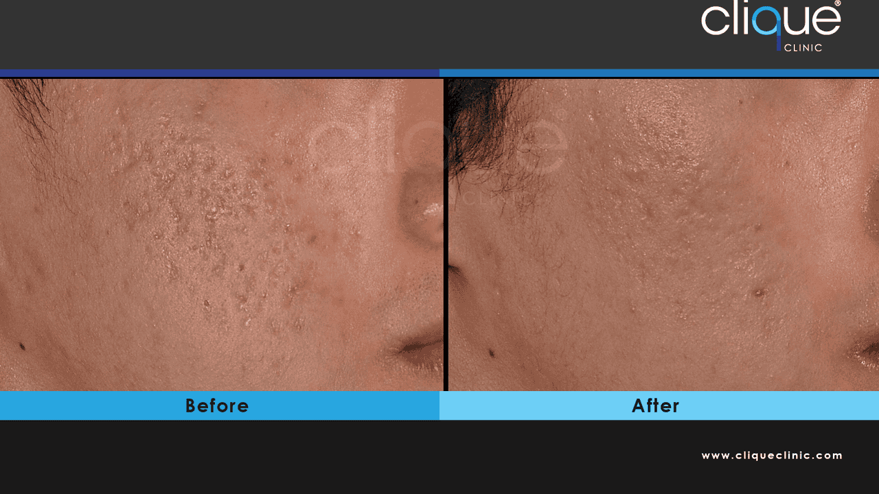 Understanding Atrophic Scars_ Causes, Prevention, & Treatments