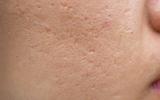 หลุมสิว Ice Pick Scar
