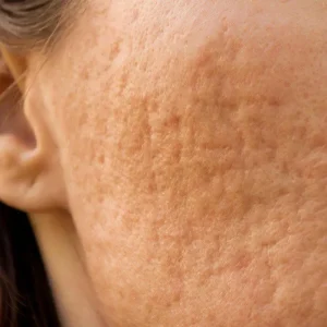 Read more about the article Understanding Rolling Scars: Causes, Prevention, & Treatments