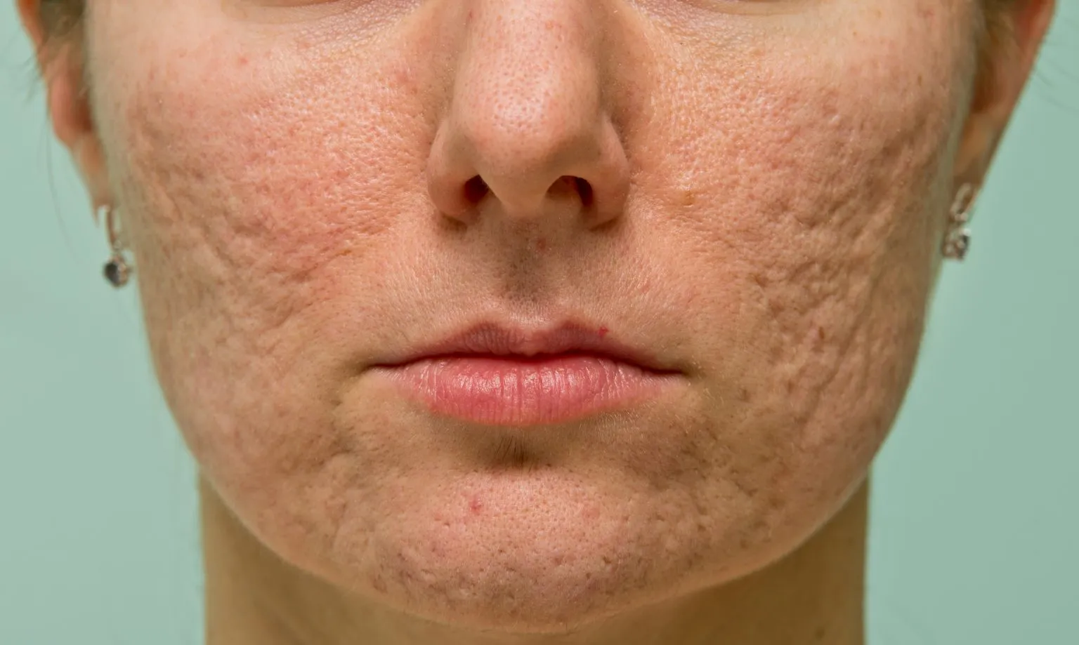 Understanding Rolling Scars Causes, Prevention, & Treatments