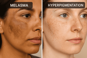 Melasma vs Hyperpigmentation: Understanding the Difference & Treatment Approaches - melasma vs hyperpigmentation understanding the difference treatment approaches 2 6 Read more about the article Melasma vs Hyperpigmentation: Understanding the Difference & Treatment Approaches