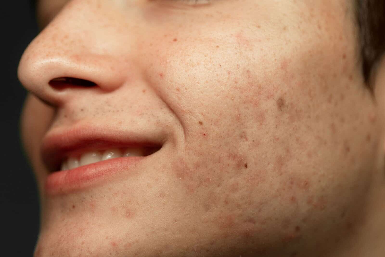 pigmentation