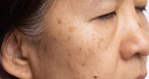 Read more about the article Chemical Peels vs. Laser Treatments for Hormonal Pigmentation