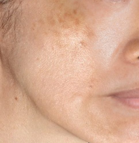 Chemical Peels vs. Laser Treatments for Hormonal Pigmentation - chemical peels vs. laser treatments for hormonal pigmentation 35