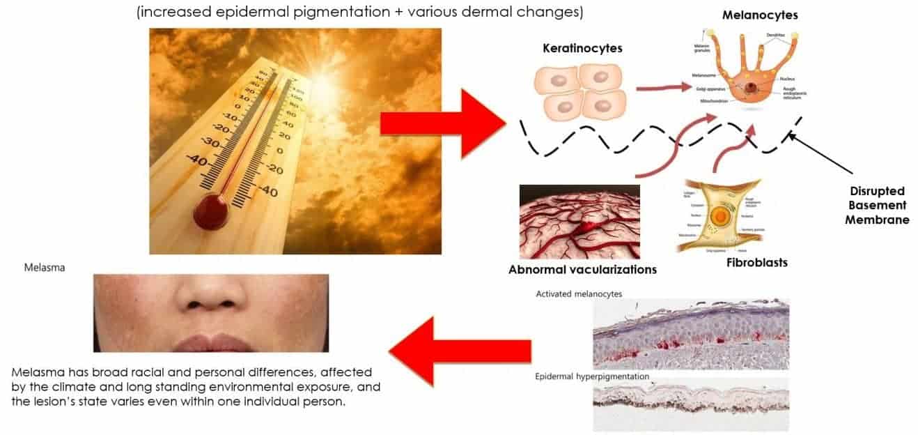 Combining Treatments for Melasma: Pico Laser + Skin Boosters - combining treatments for melasma pico laser skin boosters 3 29